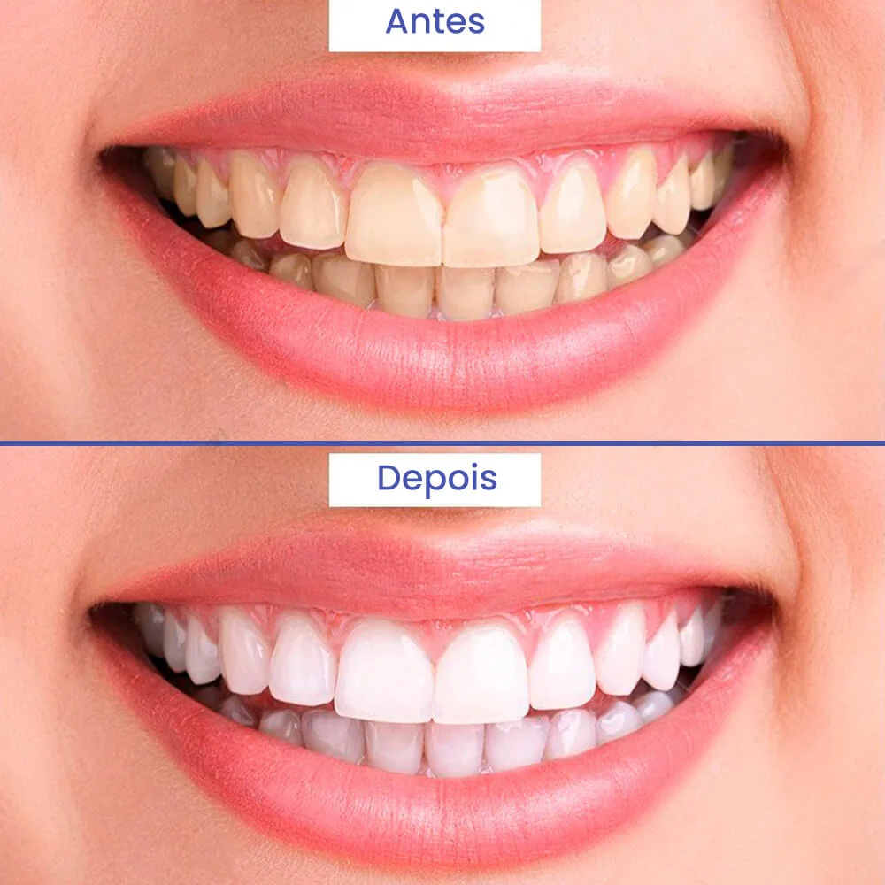 Polidor Branqueador de Dentes - SuperSmile™ - Image 5